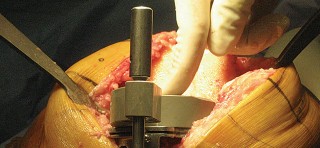 Illustration 20 for Posterior Stabilized Technique: Essential Insights for TKA Success