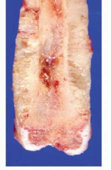 Illustration 15 for Beyond Amputation: Total Femur Resection with Endoprosthetics