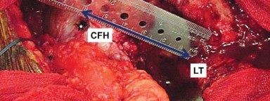 Illustration 9 for Mastering Soft Tissue Balancing for Optimal THR Outcomes