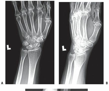 Distal Radius Fractures: What Are They & How Are They Treated?