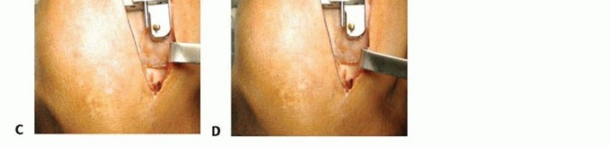 Illustration 8 for Unicondylar Knee Arthroplasty: Is This Your Solution to Knee Pain?