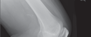 Illustration 6 for Cemented TKA Figure: Your Visual Guide to Surgical Success