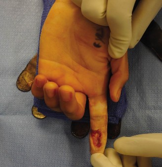 Exposed Tendon & Hand Wounds: Which Thickness Skin Graft is Best?