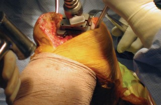 Illustration 16 for Posterior Stabilized Technique: Essential Insights for TKA Success