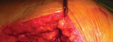 صورة طبية: تقنية الجذع القصير لاستبدال مفصل الورك الكلي: نهج الأستاذ الدكتور محمد هطيف لتدخل جراحي أقل ونتائج أفضل