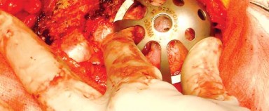 Illustration 7 for Approaches Posterolateral Surgical: A Guide to Enhanced Hip Surgery