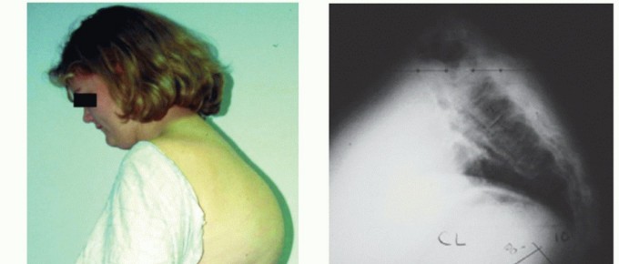 Smith-Petersen Osteotomy: Mastering Sagittal Plane Spinal Correction