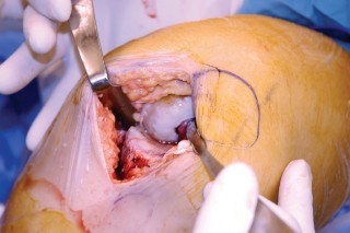 Illustration 29 for Unicompartmental Knee Arthroplasty: Master decisions with this b c figure guide.