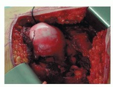 صورة توضيحية لـ ترميم مفصل الورك: الحل الأمثل للحفاظ على عظم رأس الفخذ في صنعاء مع الدكتور محمد هطيف