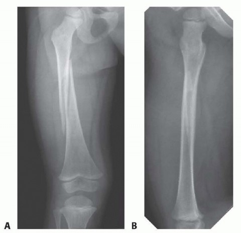 Illustration of reduction and spica - Dr. Mohammed Hutaif