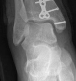 Illustration 8 for Partial Articular Fractureplate Fixation: Restore Anatomy