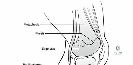 Illustration of long leg cast - Dr. Mohammed Hutaif