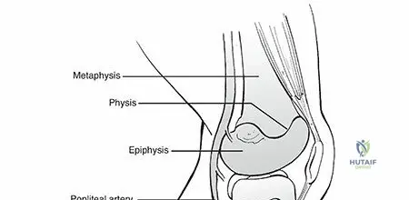 Illustration of long leg cast - Dr. Mohammed Hutaif