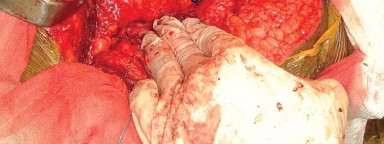 Illustration 21 for Mastering Soft Tissue Balancing for Optimal THR Outcomes