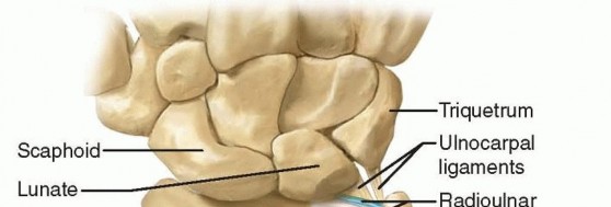 Arthroscopically Assisted Triangular Fibrocartilage Complex Débridement and Ulnar Shortening
