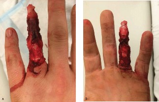 Severe Traumatic Hand Degloving & Partial Amputation: A Grand Rounds Case Presentation
