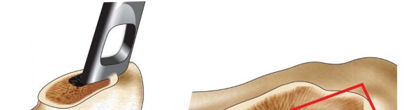 توضيح طبي: استبدال مفصل الورك الكلي بتقنية الإسمنت للفخذ: دليلك الشامل لنتائج تدوم طويلاً مع الأستاذ الدكتور محمد هطيف في صنعاء