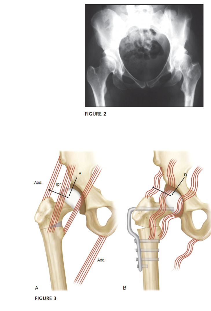 Illustration 2 for Intertrochanteric Femoral Osteotomy: Indications for Hip Preservation