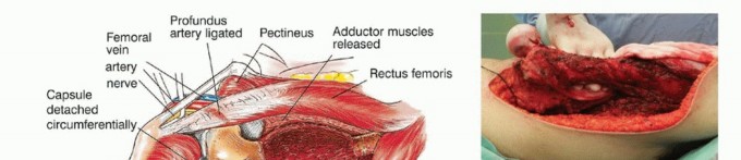 Illustration 23 for Beyond Amputation: Total Femur Resection with Endoprosthetics