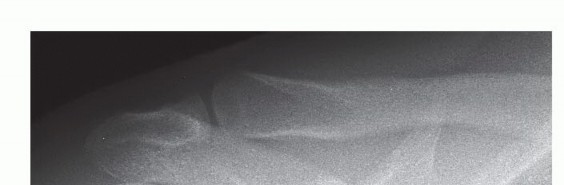 Arthroscopic AC Joint Stabilization: The Dog Bone Button Method