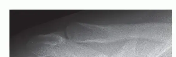 صورة توضيحية لـ تثبيت المفصل الأخرمي الترقوي بالمنظار: دليلك الشامل لكتف قوي خالٍ من الألم