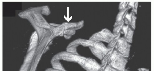 Illustration of resection of the superomedial - Dr. Mohammed Hutaif