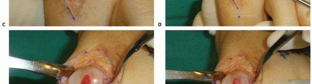 Illustration 20 for Mastering Extensive Plantar Release for Hallux Rigidus