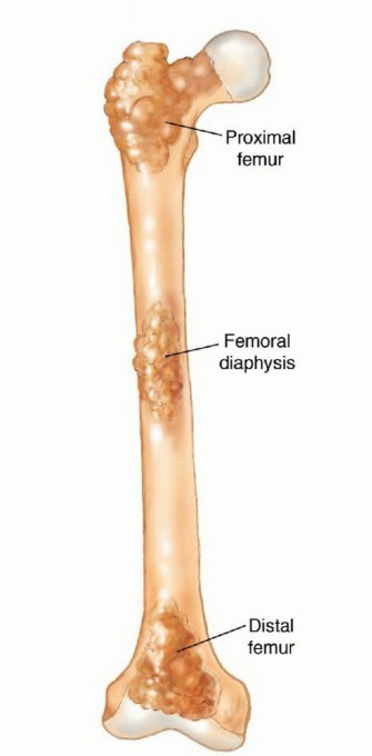 Mastering Femoral Metastases: Optimal Function for Femoris & Vastus