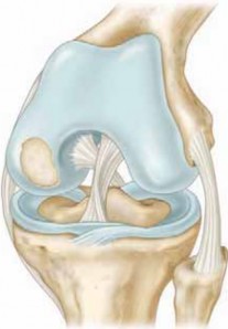 Microfracture Chondroplasty: How Tiny Holes Are Made to Fix Cartilage