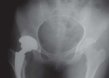 صورة طبية: مفصل الفخذ الصناعي قصير الجذع METHA: حلول مبتكرة للحفاظ على العظم في صنعاء مع الأستاذ الدكتور محمد هطيف