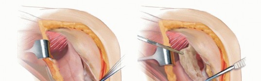 Illustration 5 for Tibial Tubercle Osteotomy: The Key to Extensile Exposure in Revision TKA