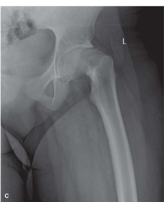 Illustration 3 for Mastering Pediatric SCFE: How to Properly Engage the Epiphysis