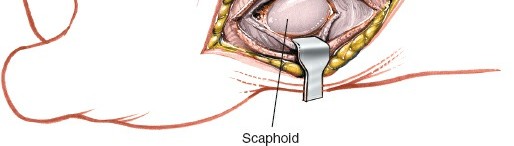Illustration 199 for Essential Surgical Approaches: Uncover Every Aspect of the Wrist