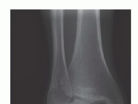What to Expect from Invasive Deltoid Ligament Reconstruction