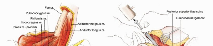 صورة طبية: استئصال نصف الحوض بالرفرفة الأمامية: حلول متقدمة لأورام الحوض الصعبة مع الأستاذ الدكتور محمد هطيف في صنعاء