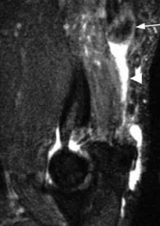 Illustration 17 for Solve Orthopedic Cases: Extensor Carpi Radialis Brevis & Elbow Pain