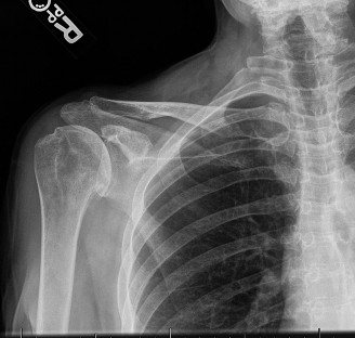 Illustration 51 for Acad Orthop Surg Challenge: Diagnose Shoulder Pain Case 1
