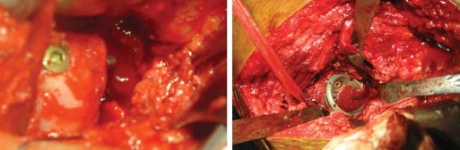 صورة طبية: استبدال مفصل الورك الكلي لالتهاب المفاصل الروماتويدي اليفعي: استعادة الحركة والأمل مع الأستاذ الدكتور محمد هطيف في صنعاء