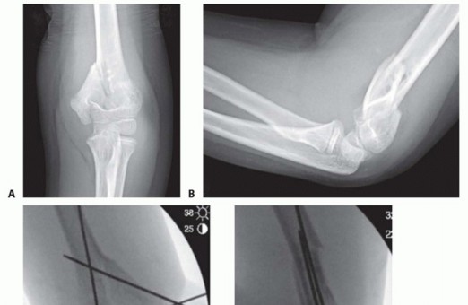 Open Reduction and Internal Fixation of Pediatric T-Condylar Fractures