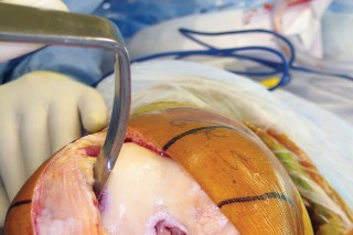 Illustration 13 for Minimize Pain, Maximize Recovery: TKA with Parapatellar