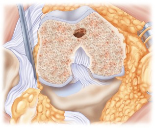 Illustration 22 for Mastering TKA: Essential Methods of Rotational Alignment