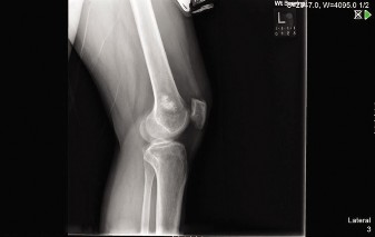 Illustration of oncology cases enchondroma - Dr. Mohammed Hutaif