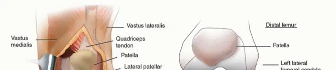 صورة توضيحية لـ قطع الحدبة الظنبوبية: دليل شامل لمرضى تبديل الركبة المراجع مع الأستاذ الدكتور محمد هطيف في صنعاء
