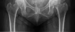 صورة توضيحية لـ جراحة استبدال مفصل الورك الهجين لكسور عنق الفخذ المتبدلة دليل شامل للمرضى مع الأستاذ الدكتور محمد هطيف