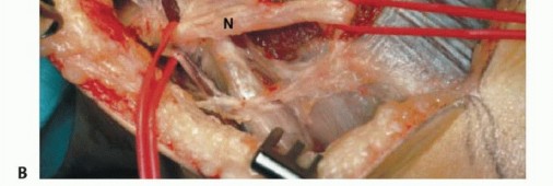 صورة توضيحية لـ استئصال أورام الشظية: دليل شامل للعلاج الحديث والحفاظ على الأطراف مع الأستاذ الدكتور محمد هطيف