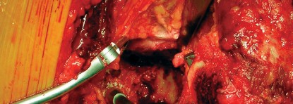 صورة طبية: طول عمر مكون الحُق الأسمنتي في مفصل الورك: مفتاح الاستقرار والديمومة مع الأستاذ الدكتور محمد هطيف في صنعاء