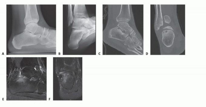 Illustration of posterior calcaneal facet - Dr. Mohammed Hutaif