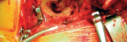 صورة طبية: طول عمر مكون الحُق الأسمنتي في مفصل الورك: مفتاح الاستقرار والديمومة مع الأستاذ الدكتور محمد هطيف في صنعاء