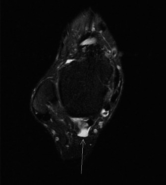 Uncover Where FHL Tenosynovitis Can Occur: A Case Study