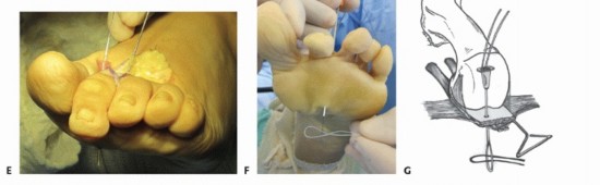 Illustration 24 for Plantar Plate Repair: End Lesser Toe Pain & Instability